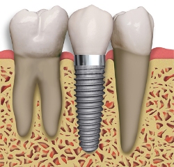glendale single tooth dental implants offered by implant dentist, Dr. Robert Thein