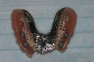 Partial snap-on dentures