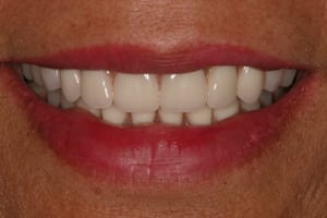 Closeup after photo of Dorothy's teeth 