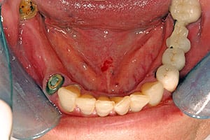 Closeup of JoAnn's bottom teeth before implants