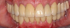 Closeup of teeth after dental implant surgery