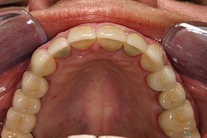Porcelain crowns and veneers case (patient J6) from Glendale dentist Dr. Robert Thein.