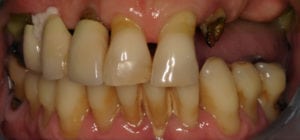 Closeup of teeth before dental implants