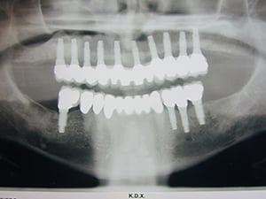 Xray of Joe's teeth
