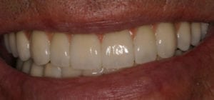 Closeup after photo of Joe's dental implants