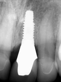 xray of dental implant