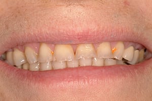 Closeup of Susan's teeth before smile makeover