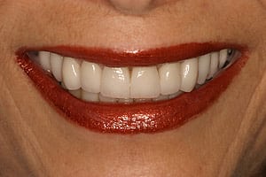 Closeup of Susan's teeth after reconstruction