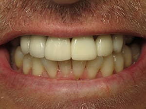 Closeup of Vinnie's teeth after reconstruction