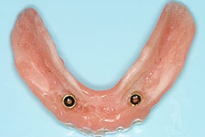 Photo of top snap on denture, available from Los Angeles implant dentist Dr. Robert Thein of Boston Dental Care.