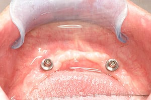 Photo of bottom piece of a snap on denture, available from Los Angeles implant dentist Dr. Robert Thein of Boston Dental Care.
