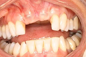 Los Angeles dental implants photo of patient (pf6-3) in the smile gallery of Dr. Robert Thein.