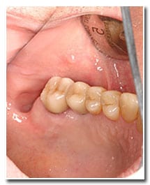 Los Angeles dental implants photo of patient (pm3-cover) in the smile gallery of Dr. Robert Thein.
