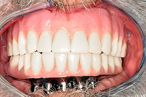 Los Angeles dental implants photo of patient (cg4) in the smile gallery of Dr. Robert Thein.
