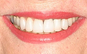 Glendale dental implants photo of patient (pf1) in the smile gallery of Dr. Robert Thein.