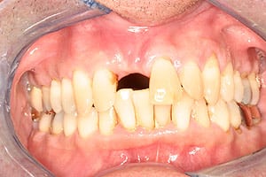 Los Angeles dental implants photo of patient (pm2-3) in the smile gallery of Dr. Robert Thein.