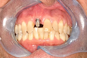 Los Angeles dental implants photo of patient (pm2-3) in the smile gallery of Dr. Robert Thein.