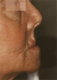 Facial collapse photo for Los Angeles implant dentist Dr. Robert Thein.
