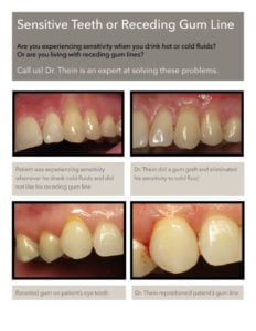 gum graft before after photos tooth sensitivity