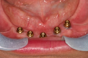 Smile gallery photo after 3 of patient (je) for Los Angeles dental implants from Dr. Robert Thein.