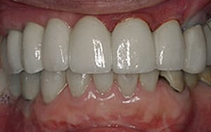 Glendale dental implants photo of patient (mag1) in the smile gallery of Dr. Robert Thein.