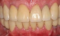 After picture of patient (J) for porcelain crowns from Glendale dentist Dr. Robert Thein.