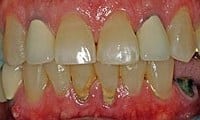 Before picture of patient (J) for porcelain crowns from Glendale dentist Dr. Robert Thein.