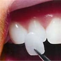 Photo of a very thin porcelain veneer held with tweezers next to natural teeth, from Glendale cosmetic dentist Dr. Robert Thein.