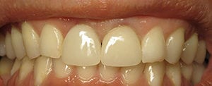 Closeup photo of Rachael's teeth before reconstruction