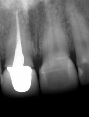 xray of cracked tooth