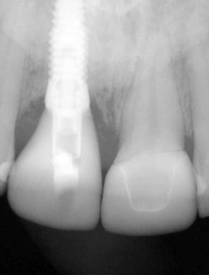xray of tooth implant