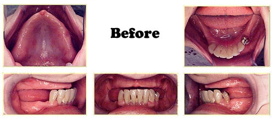 Los Angeles dental implants photo of patient (pf2-5) in the smile gallery of Dr. Robert Thein.