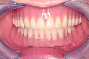 Los Angeles dental implants photo of patient (pf2-5) in the smile gallery of Dr. Robert Thein.