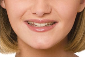 Before photo for the Snap-On Smile, which is available from Glendale dentist Dr. Robert Thein.