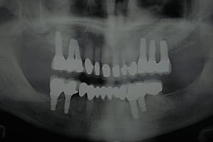 Los Angeles dental implants photo of patient (st1) in the smile gallery of Dr. Robert Thein.