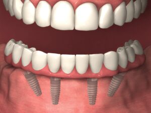 full denture implant los angeles