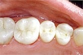 After photo of white fillings, which are available from Glendale dentist Dr. Robert Thein.