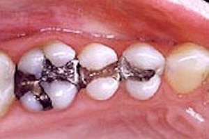 Before photo of amalgam fillings, which can be replaced by Glendale mercury-free dentist Dr. Robert Thein.