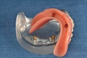 a clear acrylic model of the lower jaw showing two implants and a snap-on denture that will fit over them
