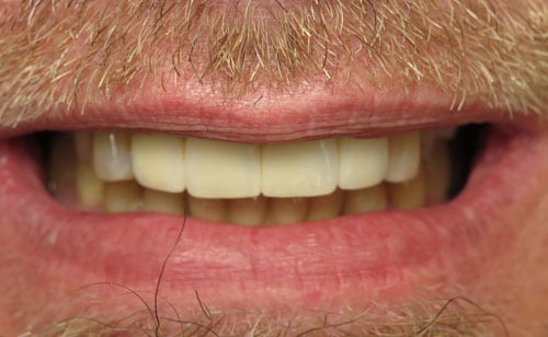 smile after dental implants