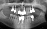x-ray of dental implants