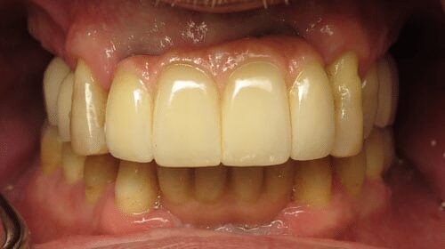 close up of completed dental implants