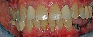 Porcelain crowns and veneers case (patient J2) from Glendale dentist Dr. Robert Thein.