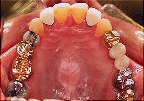 Porcelain crowns and veneers case (patient J5) from Glendale dentist Dr. Robert Thein.