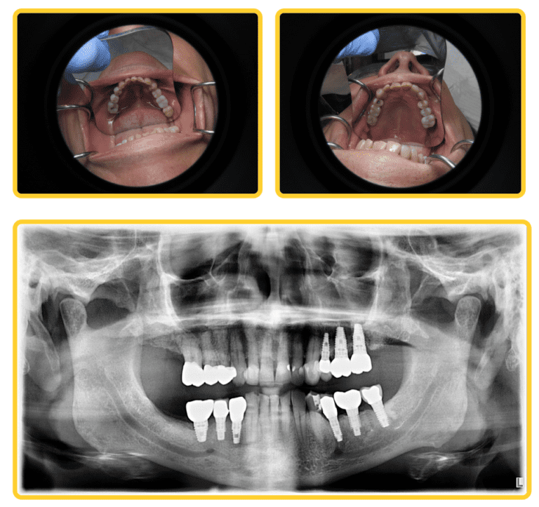 A Conservative Path to Complex Dental Implant Reconstruction