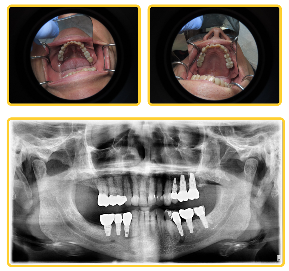 dental implant La Crescenta