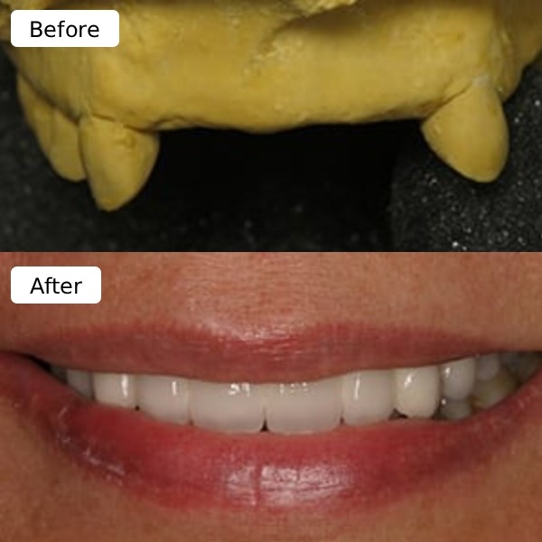 Dental restoration work sample