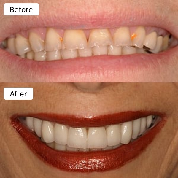 Smile makeover sample