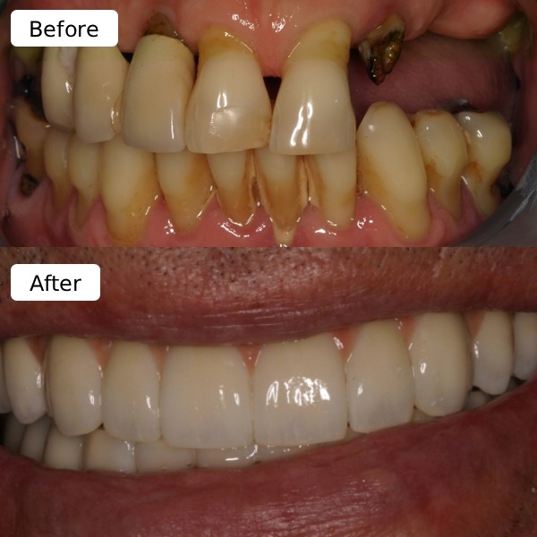 Porcelain crown sample