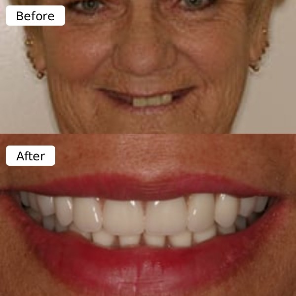 Dental implant result